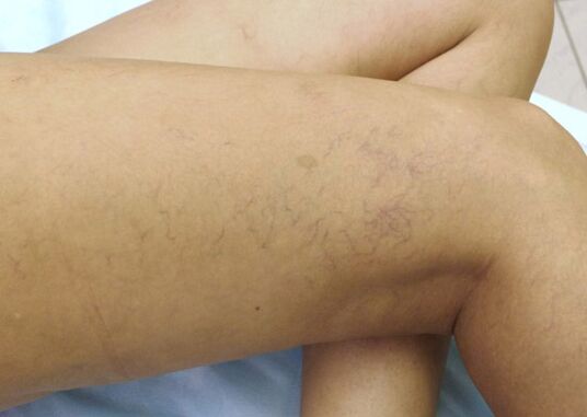 Vasküler yıldızlar