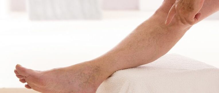 Bacaklarda varisli damarlar